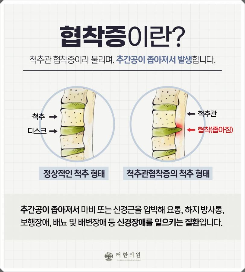 정상 척추와 협착증 척추를 비교한 그림