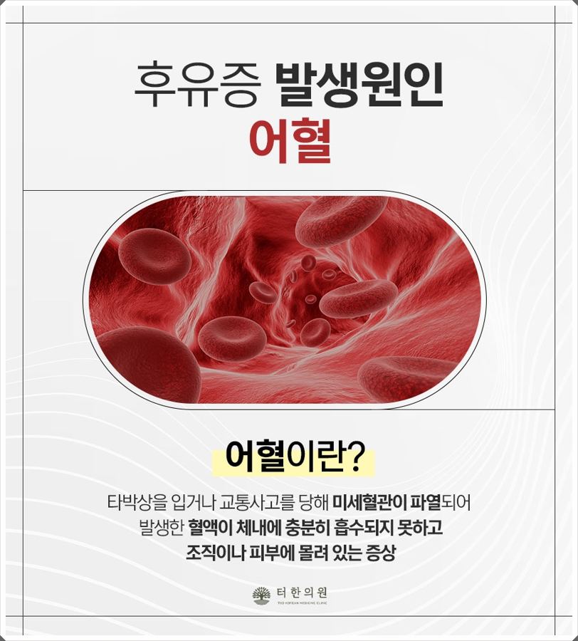 어혈을 설명한 적혈구 안내문