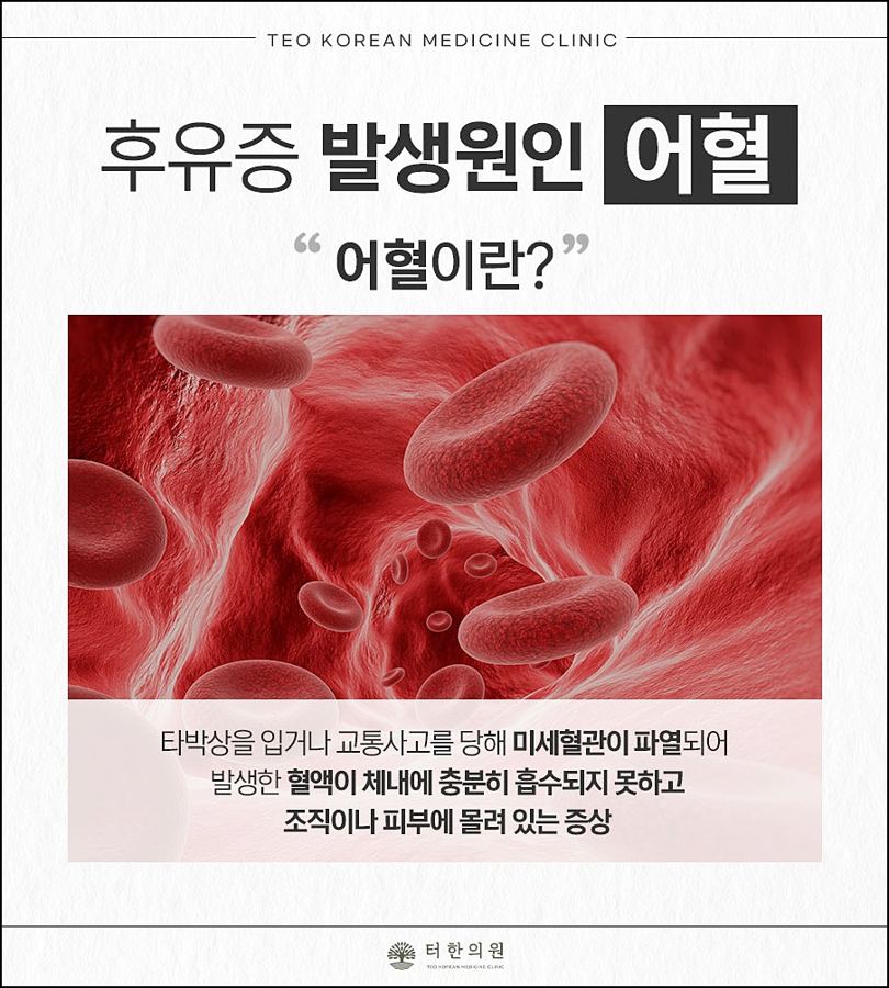 어혈을 설명한 적혈구 안내문