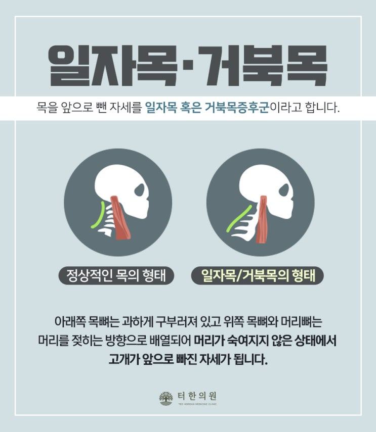 일자목과 거북목 자세를 비교한 그림