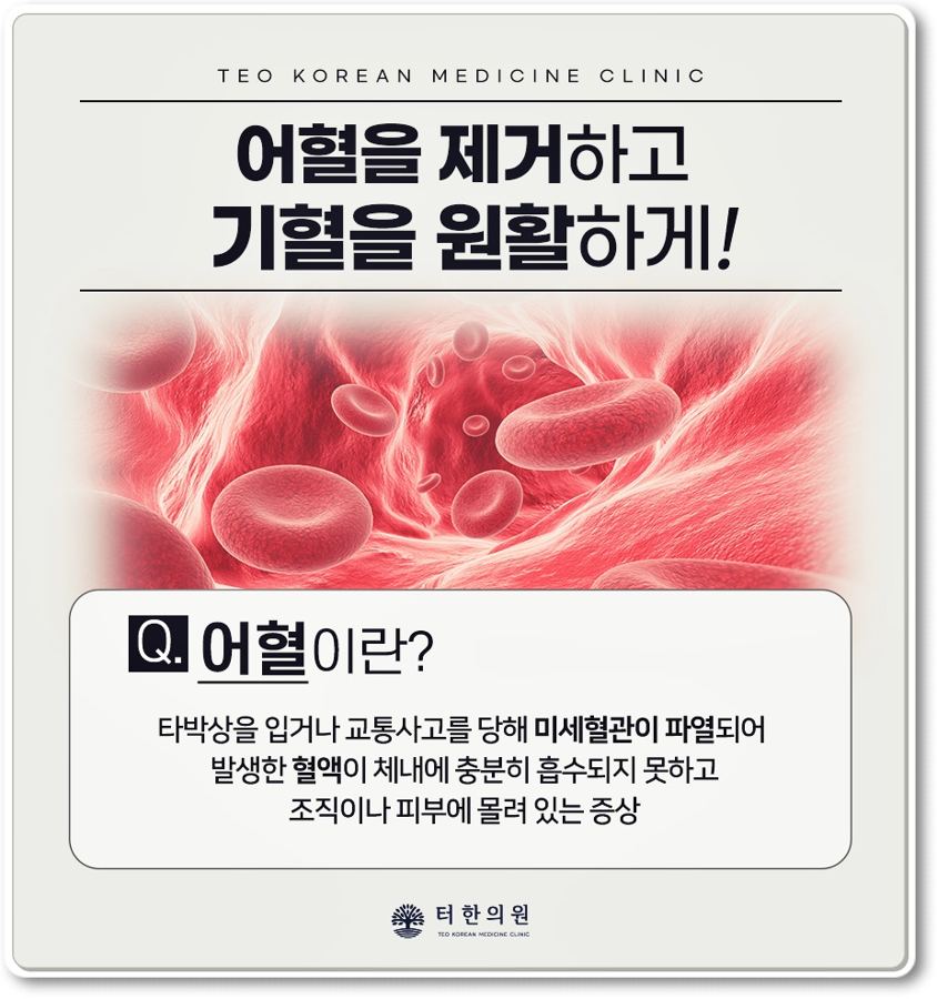어혈 제거와 기혈 순환을 설명하는 카드뉴스